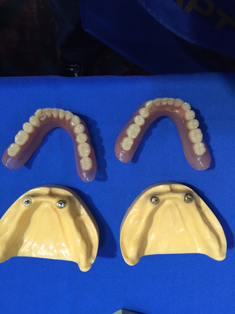 Implant Supported Overdenture - Lower