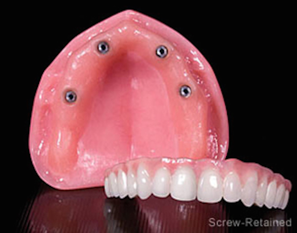 Implant Over Denture