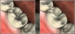 Replacing mercury fillings - before and after