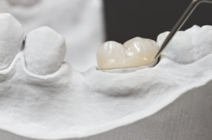 dental onlay on a cast model