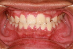 A person with gingivitis