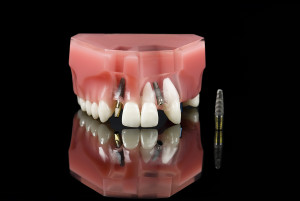 Wisdom Tooth, Dental Implant And Teeth Model
