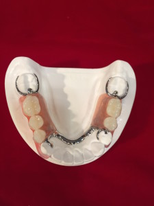 combo metal-resin partial lower denture