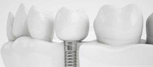 screw-retained-dentures