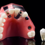 Dental Implant Model