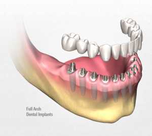 dental-implants-rotate3
