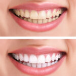 Fixing Troubled Teeth With Porcelain Veneers