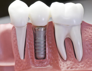 What Makes Dental Implants Worth The Cost?
