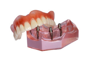 Eliminate Unwanted Pastes And Glues From Your Denture Wearing Routine With An Upper Implant Overdenture