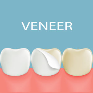 Things That Long Island Residents Should Know About Porcelain Veneers