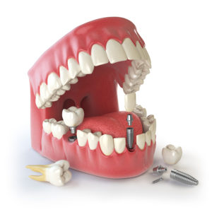 the-2-parts-Of-a-denture-appliance
