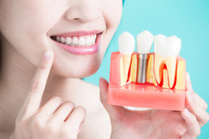 How Do I Take Care Of My New Dental Implants?