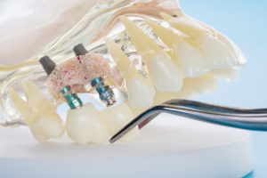 Different Needs Get Different Dental Implants