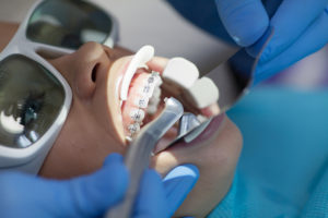 How Lasers Improve Dentistry