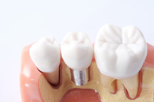 What Is Osseointegration?