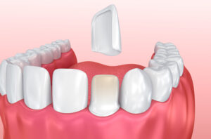 Dental Veneers: