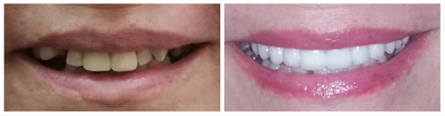 Smile makeover before and after