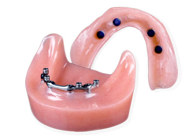 Bar Supported Overdentures with Implants
