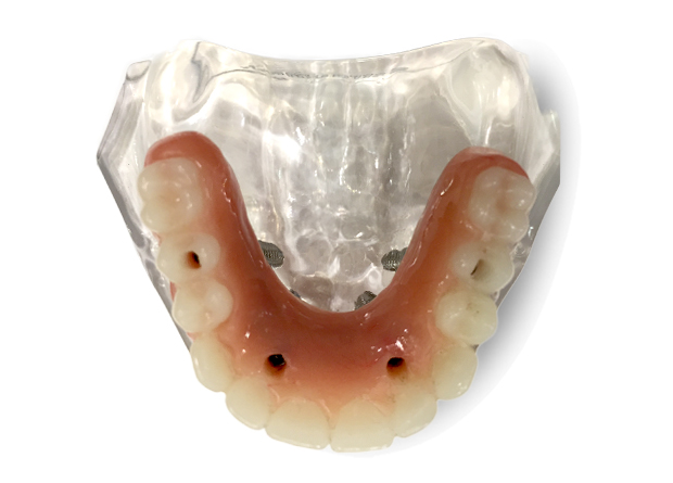Open Palate Implant Supported Dentures