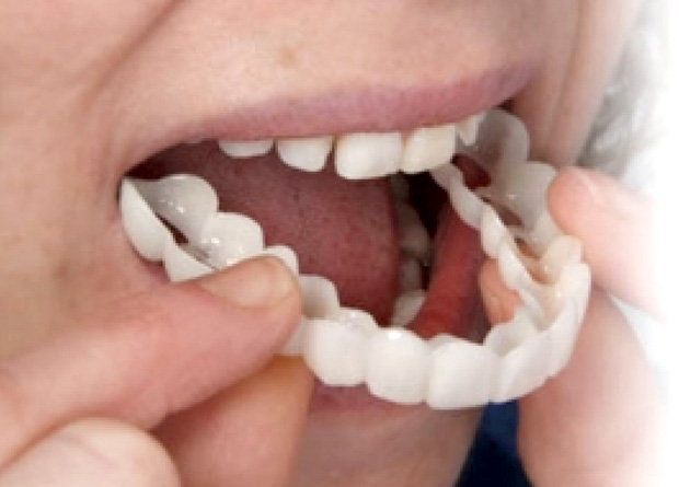 Snap on Dentures with Implants