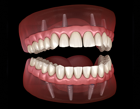 Dental Implant Supported Denture
