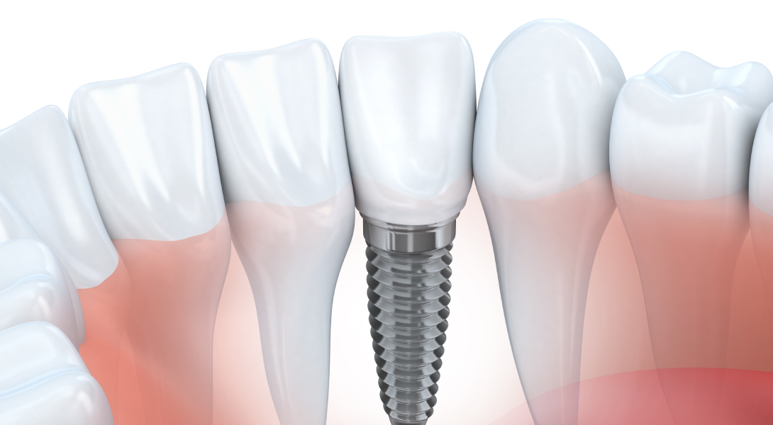 How Long Do Dental Implants Last? Get the Facts from Your Cosmetic