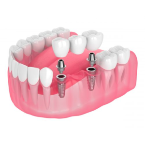Multiple Teeth Replacement Option