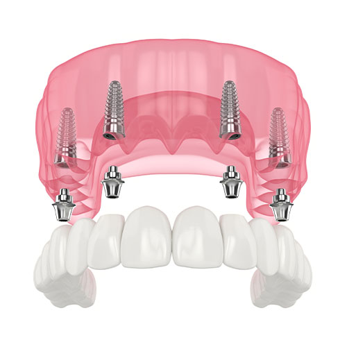 Full mouth dental implant restoration All-on-4 or All-on-6