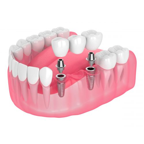 Multiple teeth dental implant bridge