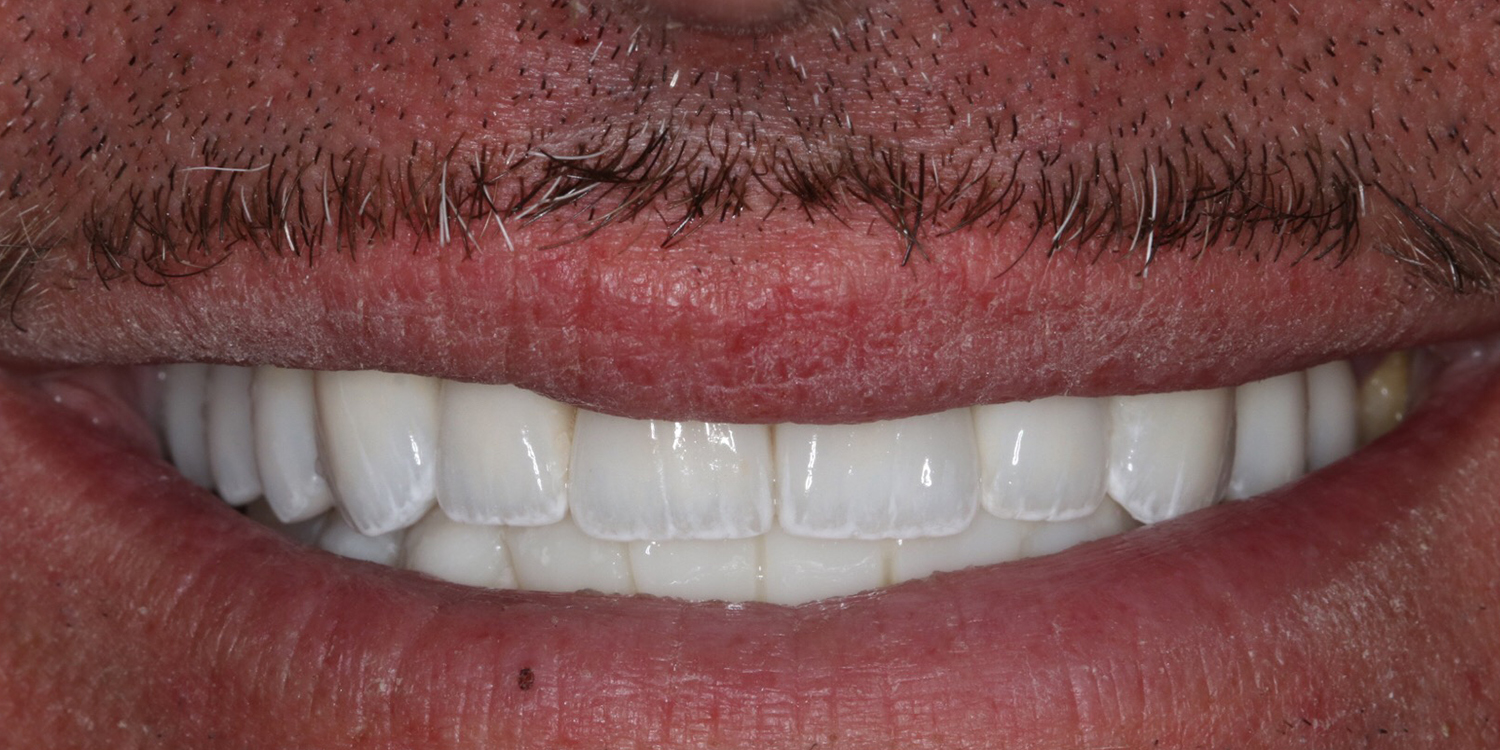 teen boy after invisalign