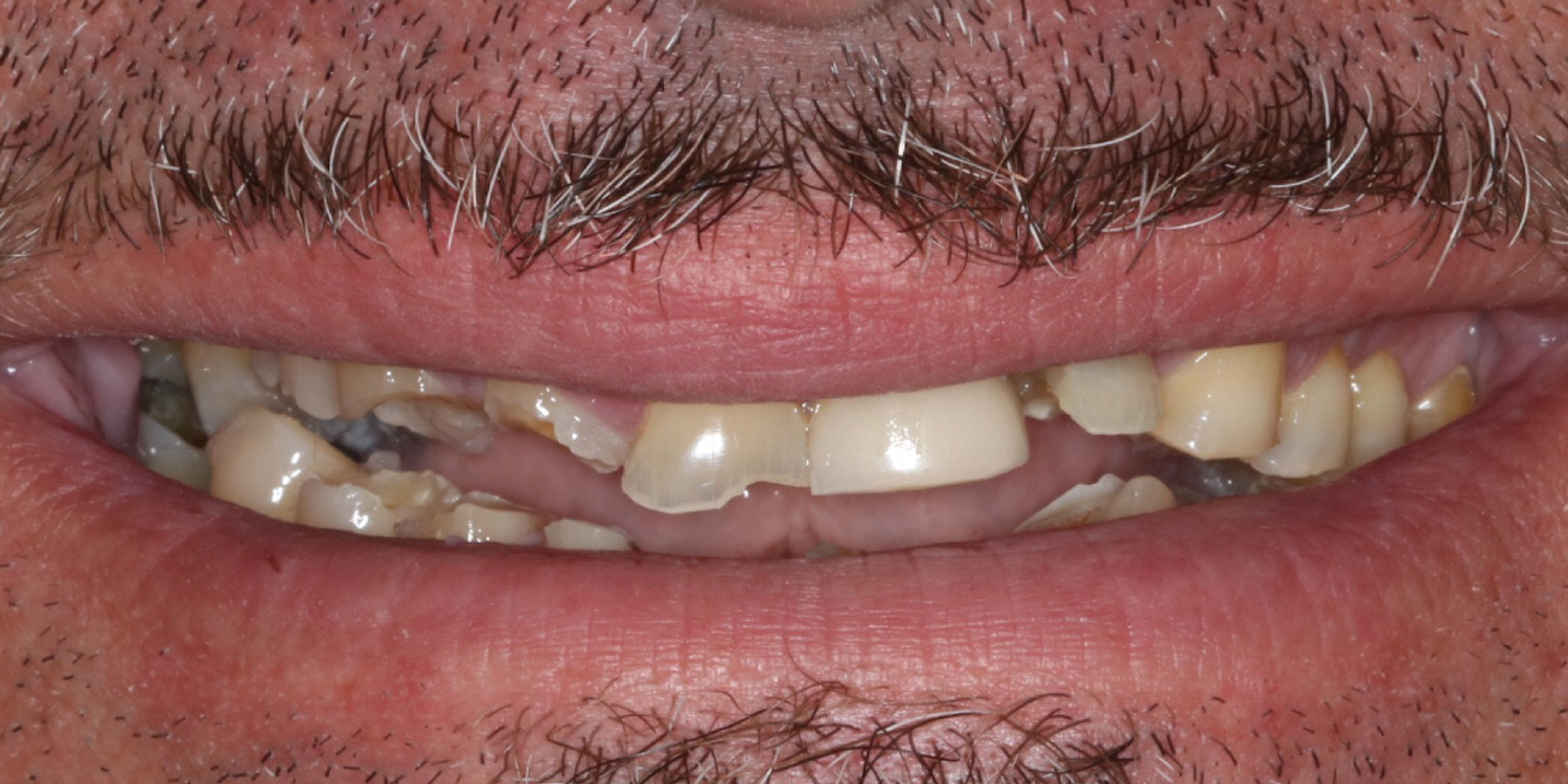 teen boy before invisalign