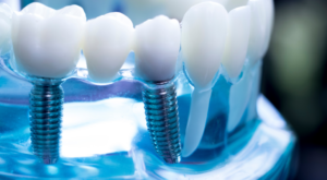 Dental Implants