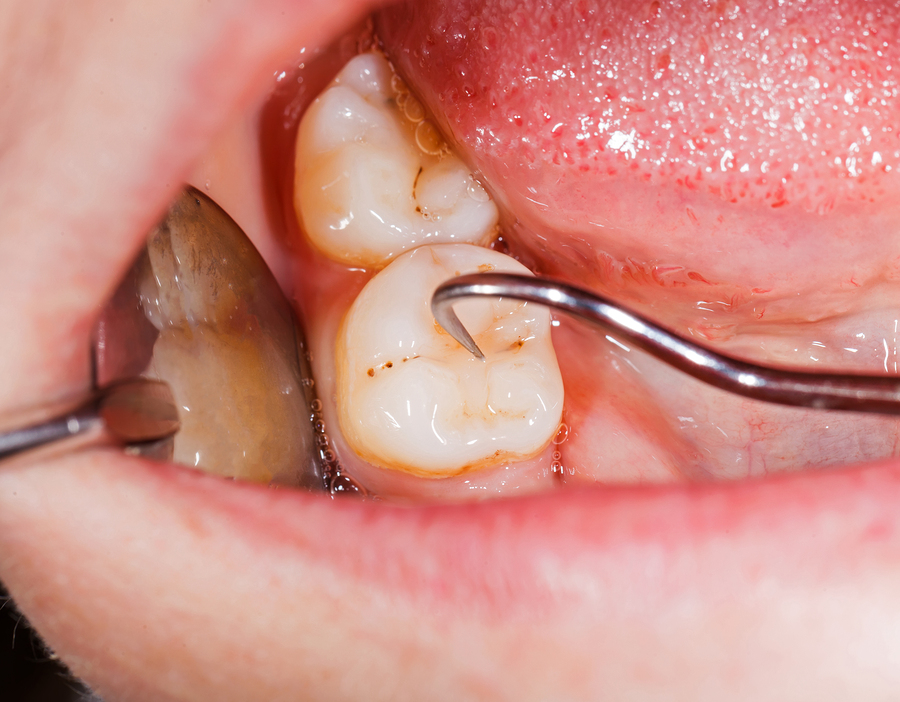 Managing Your Periodontal Disease