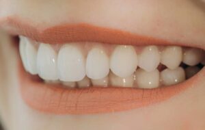 Dental Veneers