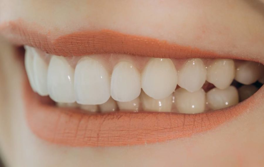 Dental Veneers