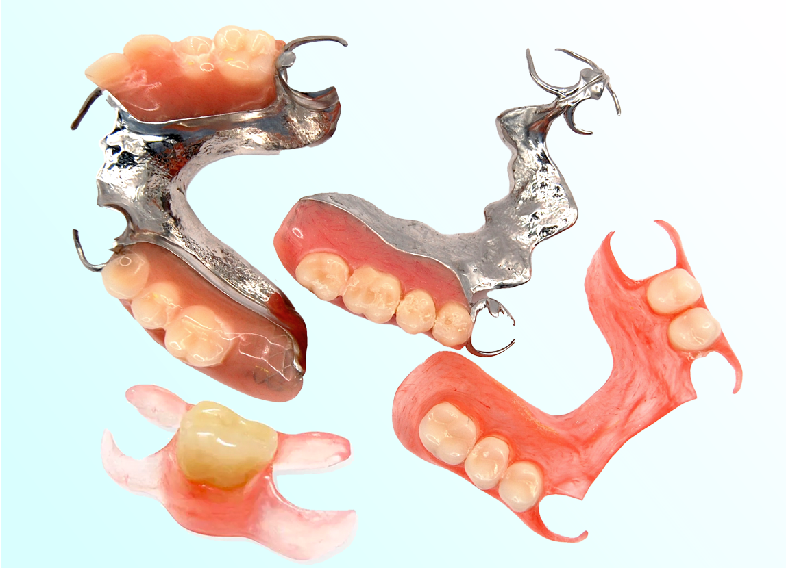 Cast metal framework partial denture with attached replacement teeth
