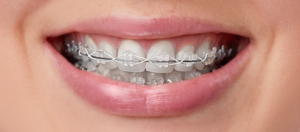 A Guide to Orthodontic Treatment Options Exploring Orthodontic Solutions
