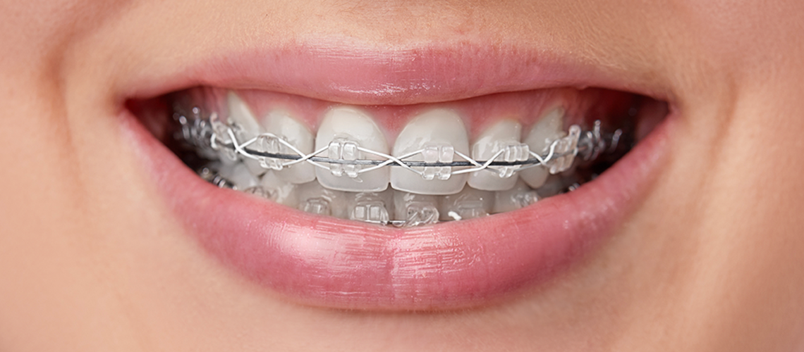 A Guide to Orthodontic Treatment Options Island Dental Associates