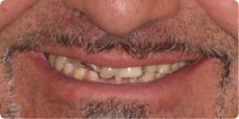 dental Implants before and after