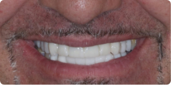 dental implants before and after