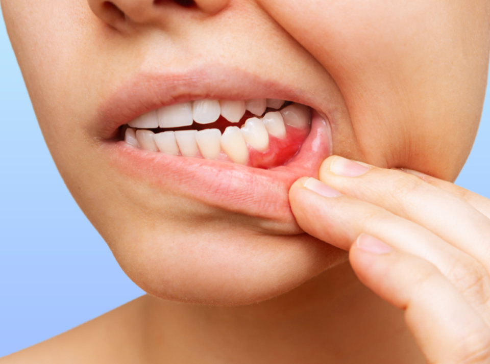 Dental care periodontal disease