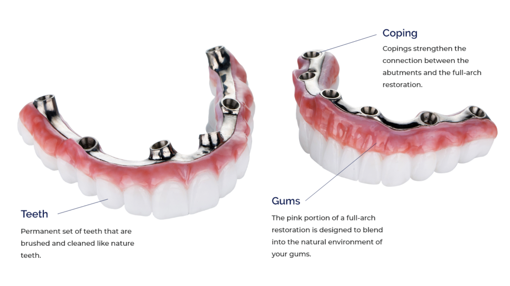 Full-Mouth Dental Implants All-On-X, All-On-Four full mouth dental implants near me