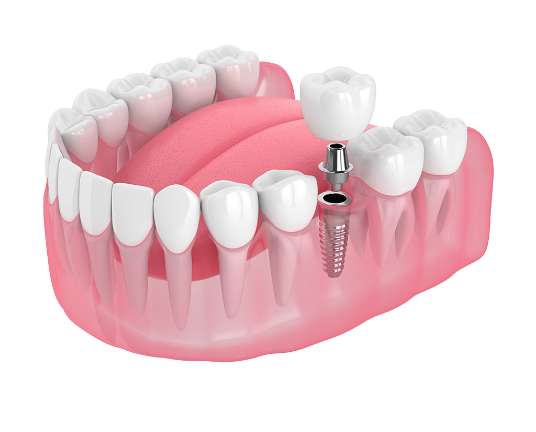 Single tooth dental implant — natural-looking permanent replacement
