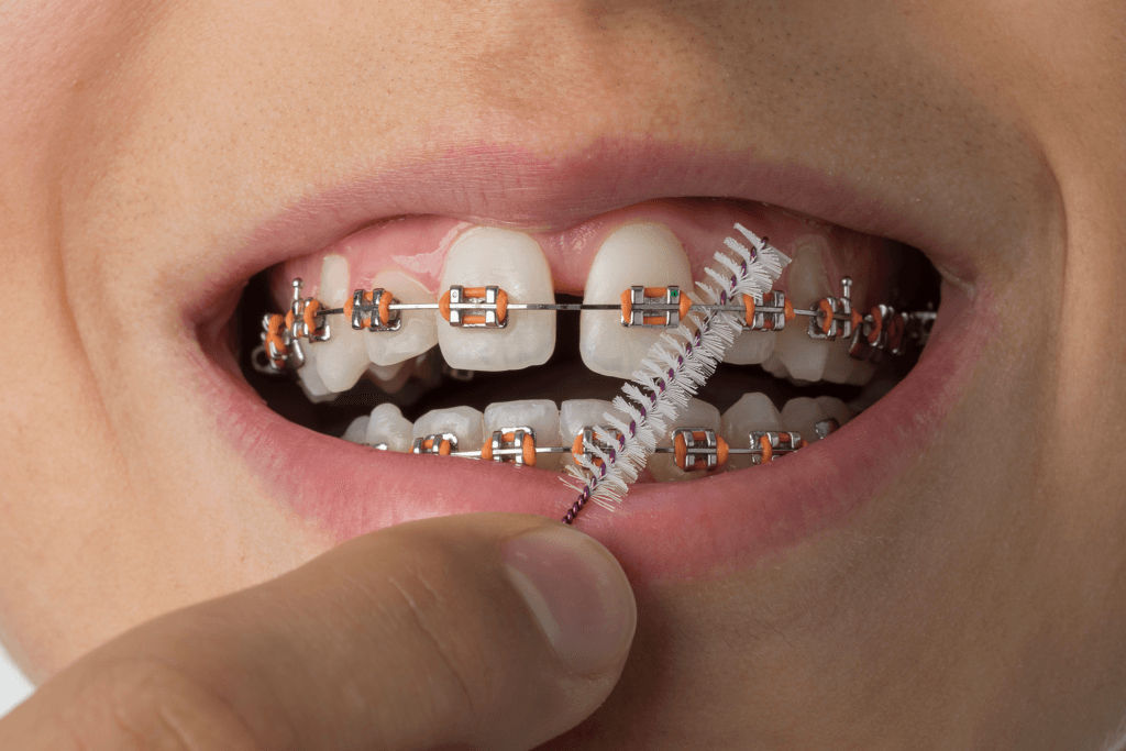 All you need to know about orthodontic braces
