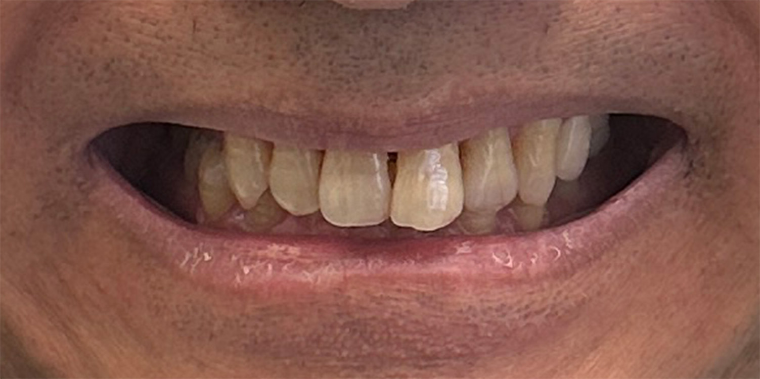 teen boy before invisalign