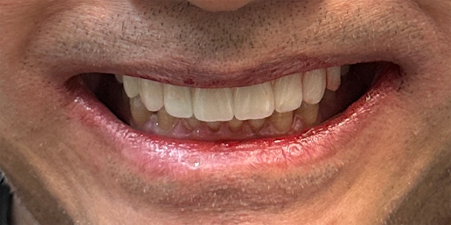 teen boy after invisalign