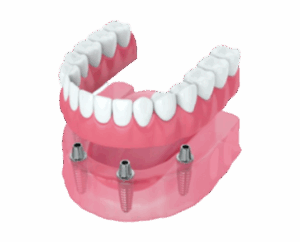 snap-on-implant