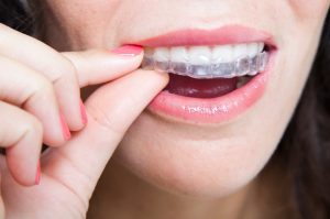 You can straighten your teeth with clear braces
