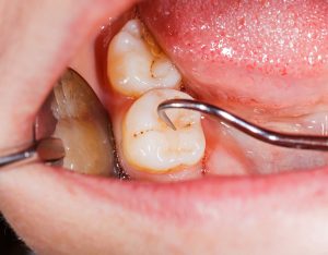 Managing Your Periodontal Disease