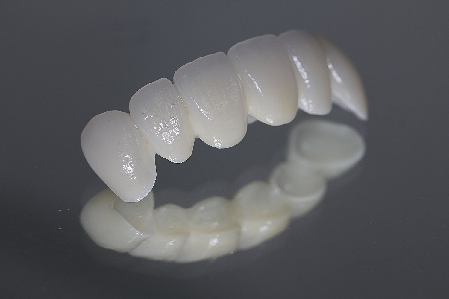 Implant bridge — multiple teeth restored with implant support